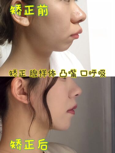 凸嘴矫正腺样体肥大矫正器