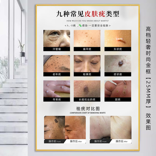 祛痣祛疣海报扁平疣广告祛斑挂画