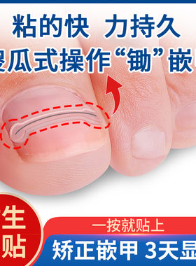钢丝嵌甲矫正贴片记忆金属甲沟矫正器炎正甲贴趾甲贴片指甲长肉里