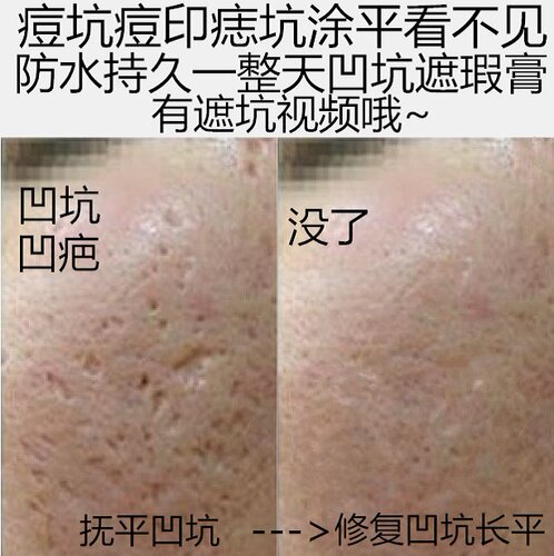 遮痘坑痘印填凹洞遮瑕膏笔痘痘凹疤痕遮盖毛孔贴男女脸部持久神器