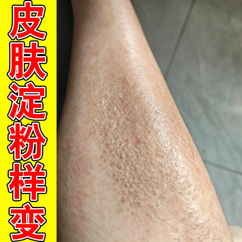 皮肤淀粉变腿上长小颗粒疙瘩小腿痒粗糙痘干燥外用腿痒