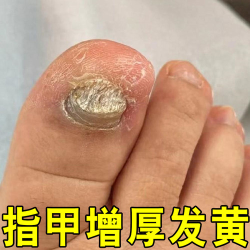 指甲增厚变黄脚趾甲增厚发黄坏甲药无痛脱落坏甲板浑浊泛黄膏