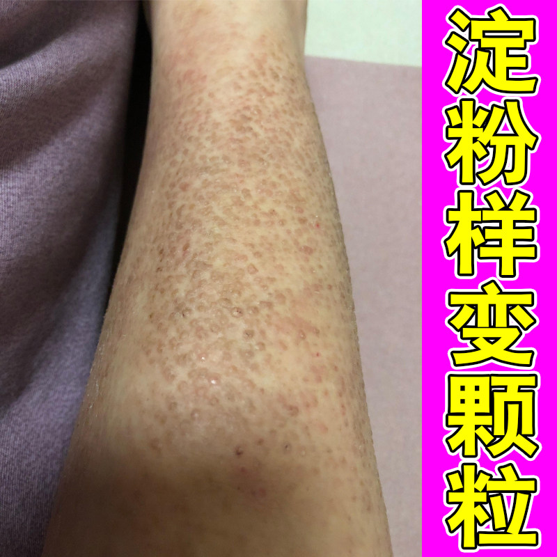 小腿粗糙颗粒色素沉淀改善皮肤干燥增厚发痒长硬疙瘩小颗粒专用膏