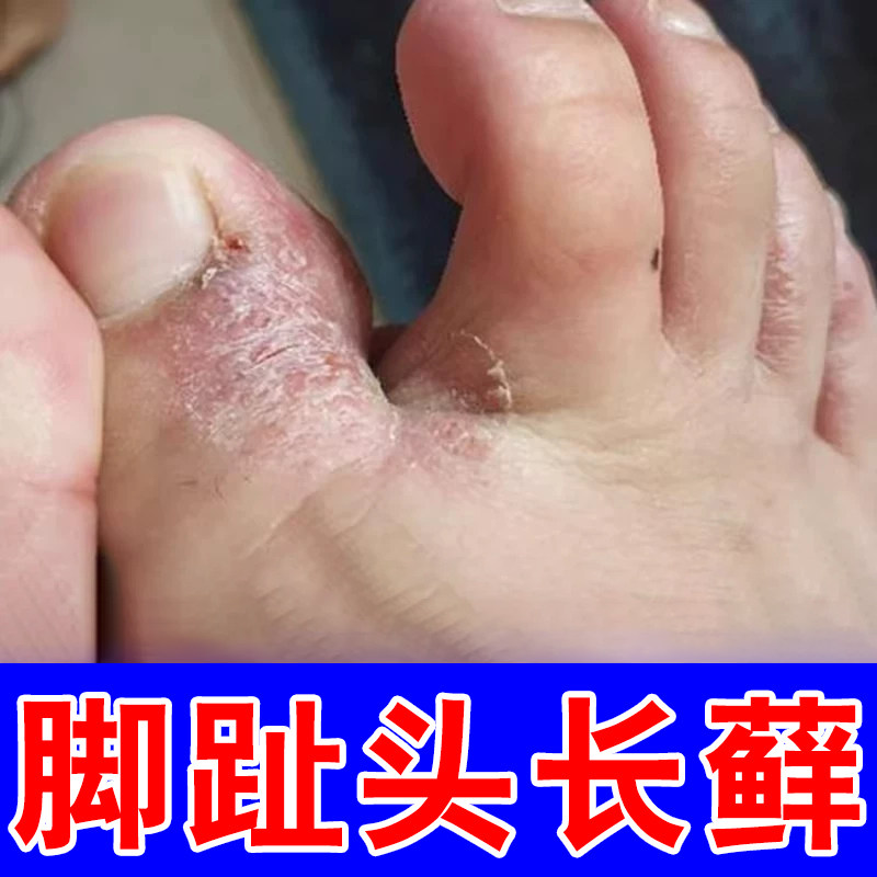 脚趾头干燥粗糙痒脚背痒开裂脱皮脚趾缝起皮掉屑脚后跟干裂修复霜