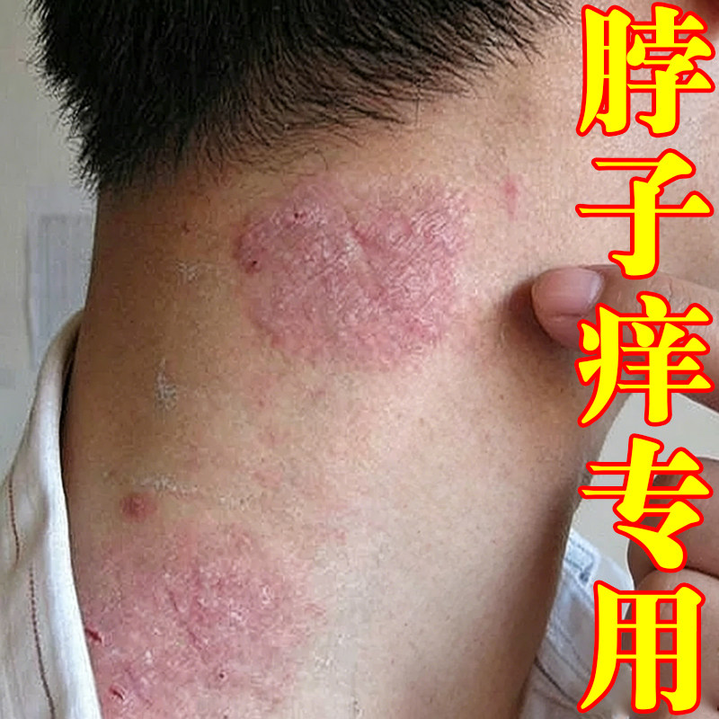 脖子后面长红斑脖圈红痒刺挠颈部上起红疙瘩过敏神经性皮肤痒专用