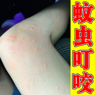 蚊虫叮咬疙瘩腿上痒起红点痒外用药身上痒起红疙瘩小腿痒外用软膏