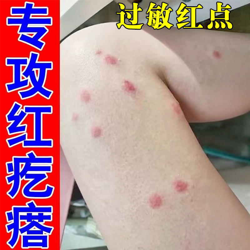 身上疙瘩痒蚊虫叮咬跳蚤咬虫咬性过敏丘疹红肿痘痘床虱疥螨专用膏
