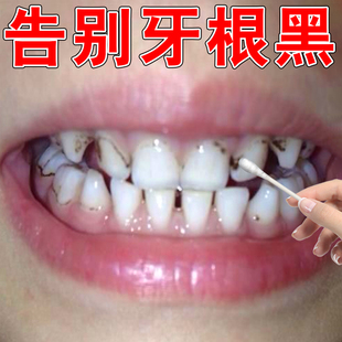 牙根发黑牙垢牙菌斑牙烟渍牙斑净牙缝发黑清理神器氟斑牙药