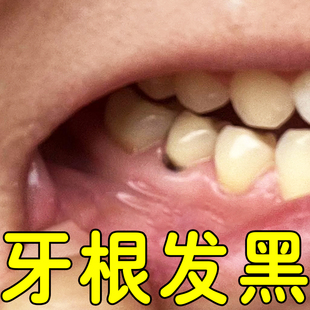 牙根发黑牙斑净牙缝发黑清理神器牙菌斑洗牙齿污垢牙黄牙垢