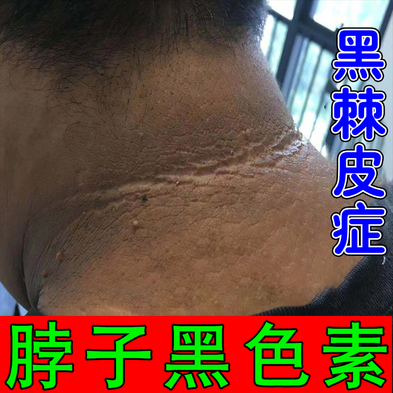 去脖子黑棘皮膏药脖子黑色素去除颈部霜神器脖子黑黑的黑棘皮症膏