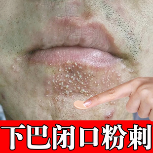 去下巴闭口粉刺黑头痘痘膏熬夜上火下巴长痘痘冒白头白尖疙瘩疼痛