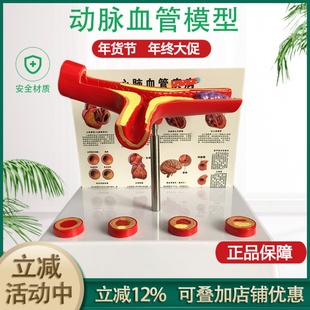 人体支脉粥样11硬化 心血管动脉1解剖模型 血栓 模型人体血管模型