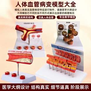 人体支脉粥样11硬化 心血管动脉1解剖模型 血栓 模型人体血管模型