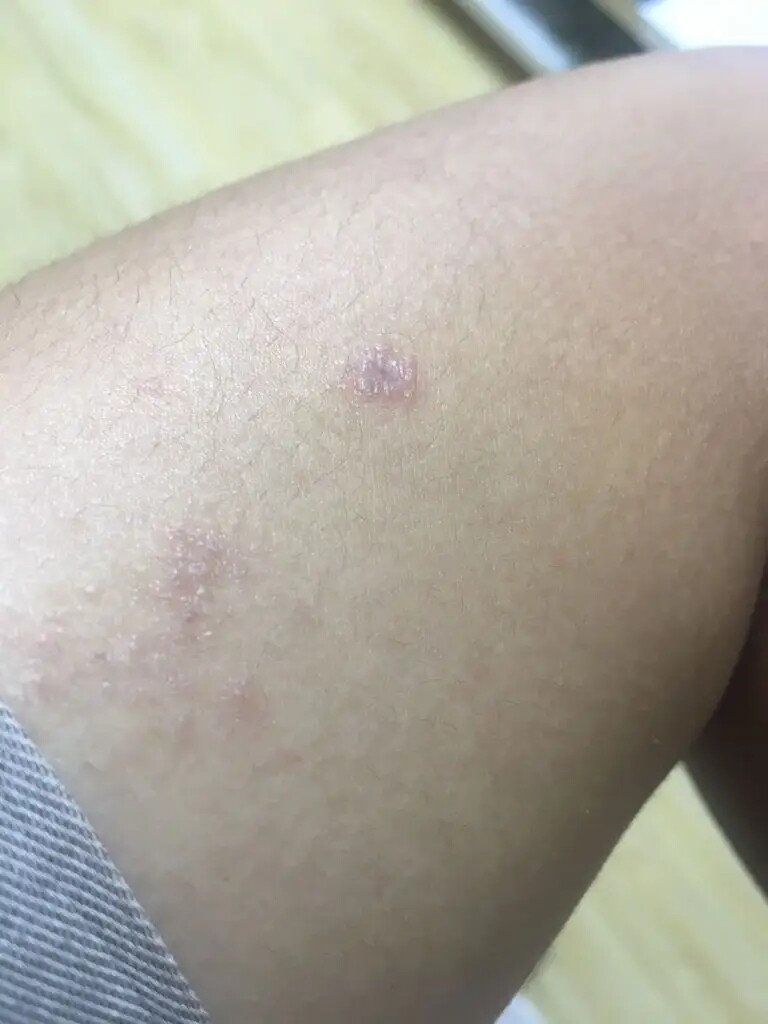 大腿内侧潮湿发痒大腿根两侧干痒长红斑起皮越挠越痒男女通用乳膏