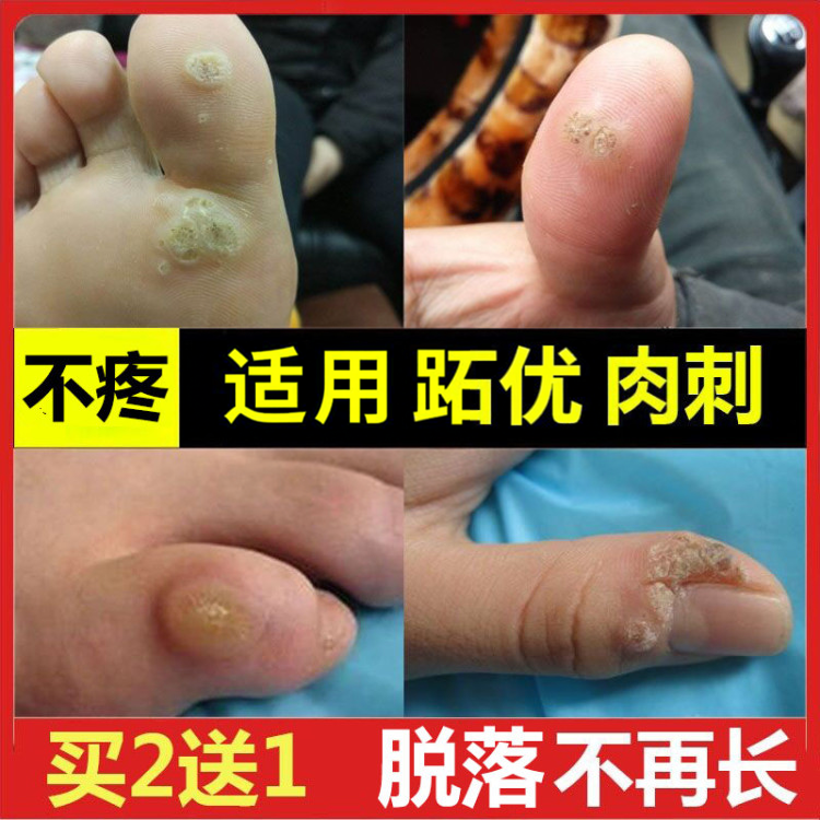 跖由肉刺子血胞老茧死皮关节茧甲周病毒优鱼休子茧鸡膏贴脚底手上
