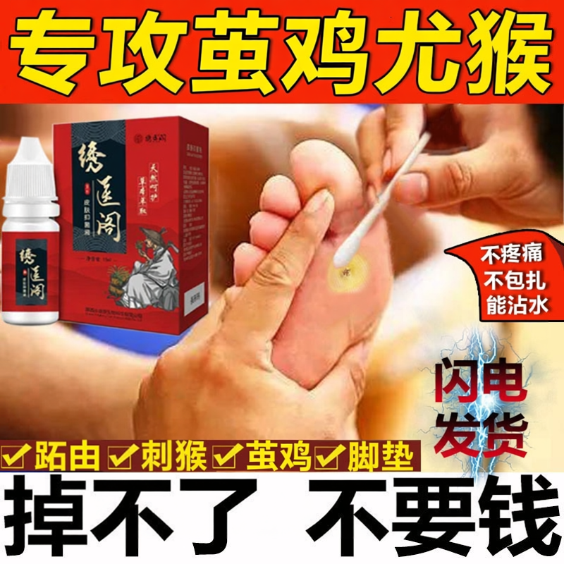 绣医阁鸡茧净跖优膏去脚老茧刺猴手足部脚底根刺猴休子肉刺去优灵
