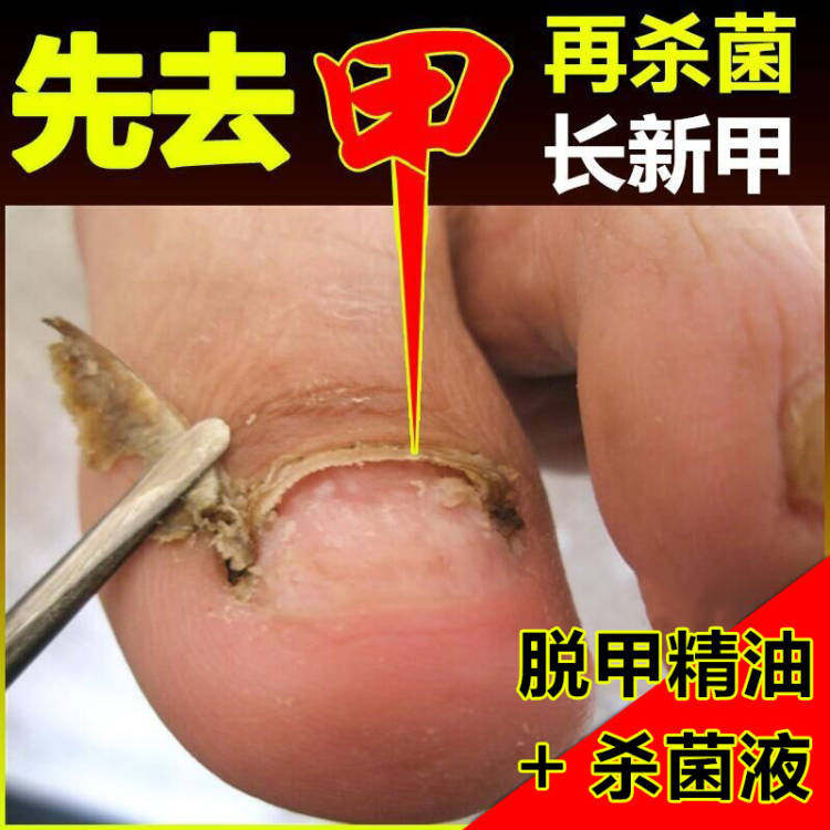 灰趾甲增厚脱甲液软甲膏灰甲清去除手脚发黄厚指甲新亮灰甲净正品