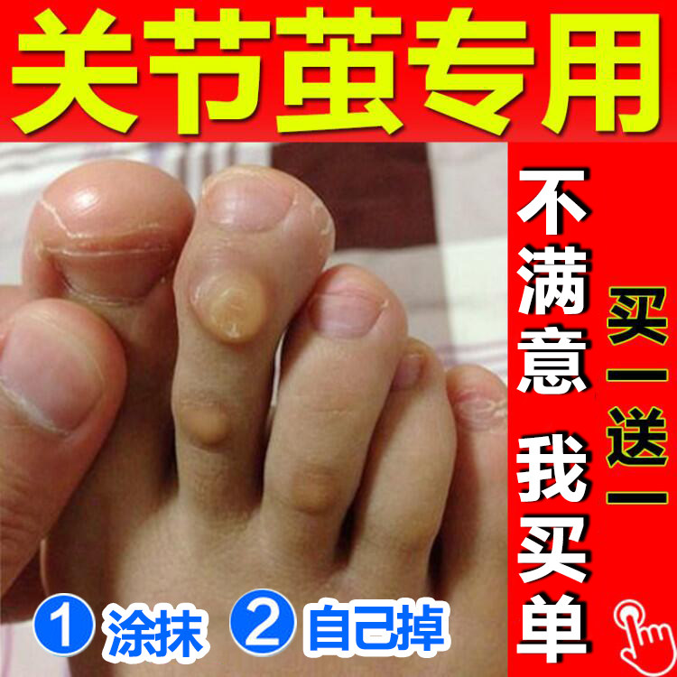 绣医阁茧净手脚茧老茧脚垫除脚趾关节茧去死皮鸡厚茧眼膏贴肉刺液