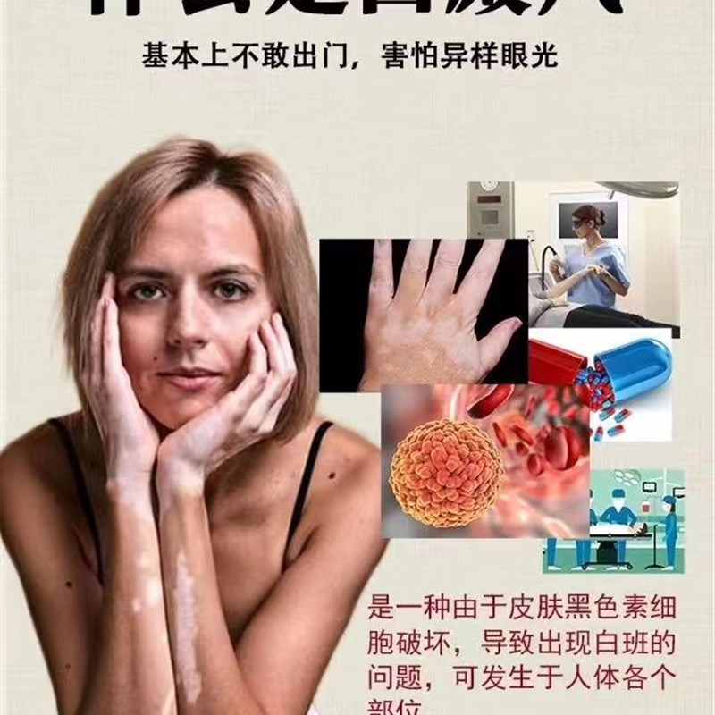 白癜风药膏e乳膏卢芦消可替尼白斑效特别孟版外用生长药