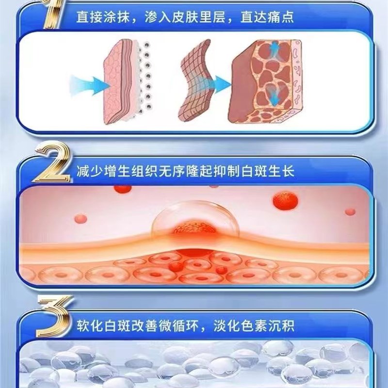 白癜风药膏乳膏卢芦消可替C尼白斑药膏有效孟版外用生长