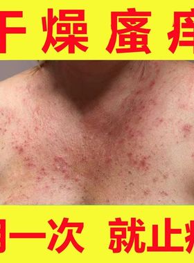 全身身上痒冬季皮肤瘙痒干燥起红疙瘩红点外用药老年人止痒抑菌膏