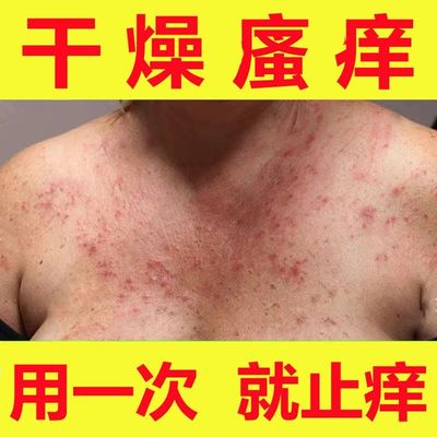 全身身上痒冬季皮肤瘙痒干燥起红疙瘩红点外用药老年人止痒抑菌膏