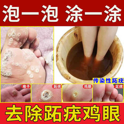 去瘊子药跖疣专用膏根去瘊灵肉粒疙瘩拓疣鸡眼膏贴肉刺趾尤泡脚粉