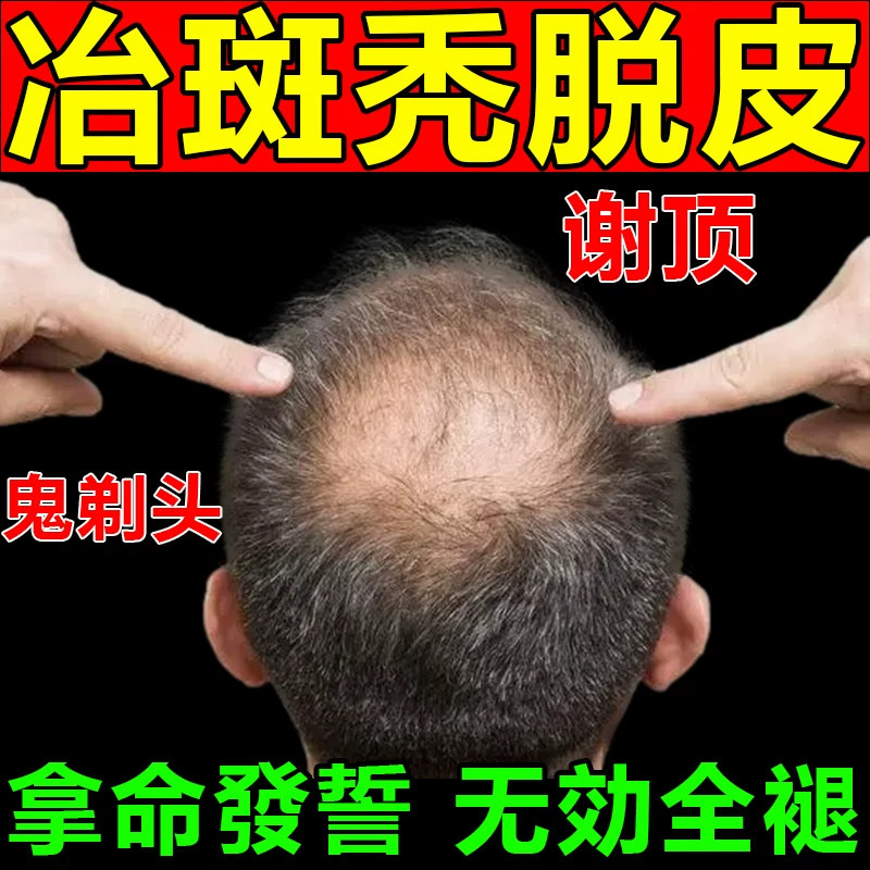 胱氨酸片生发山西汾河生发治疗抗病毒产后脱发严重男专用女士生发