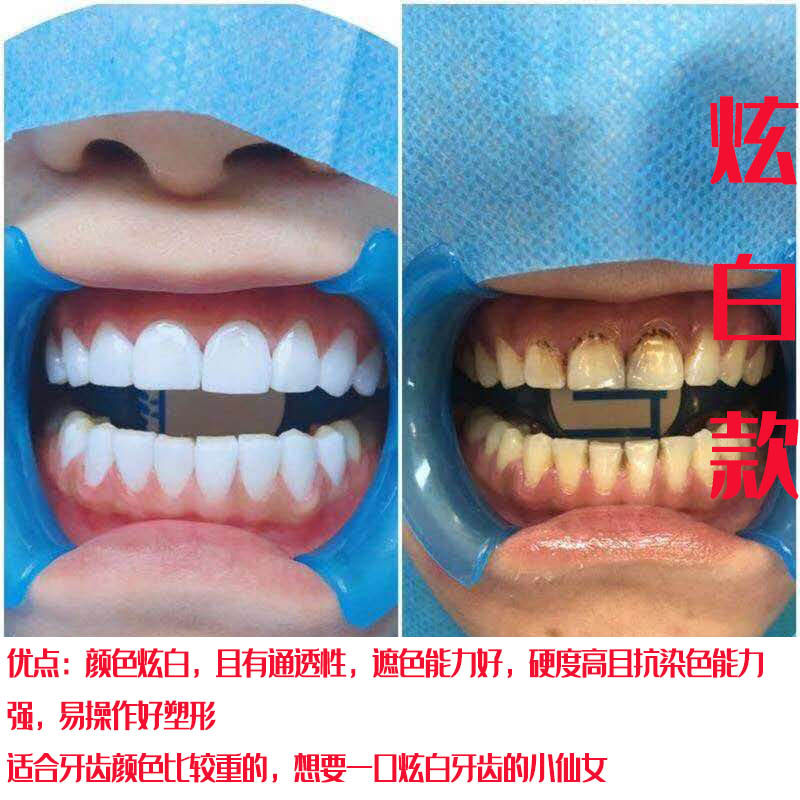 6d纳米炫齿浮雕 牙齿美白 美牙贴面树脂贴面 个人美牙套装 送视频