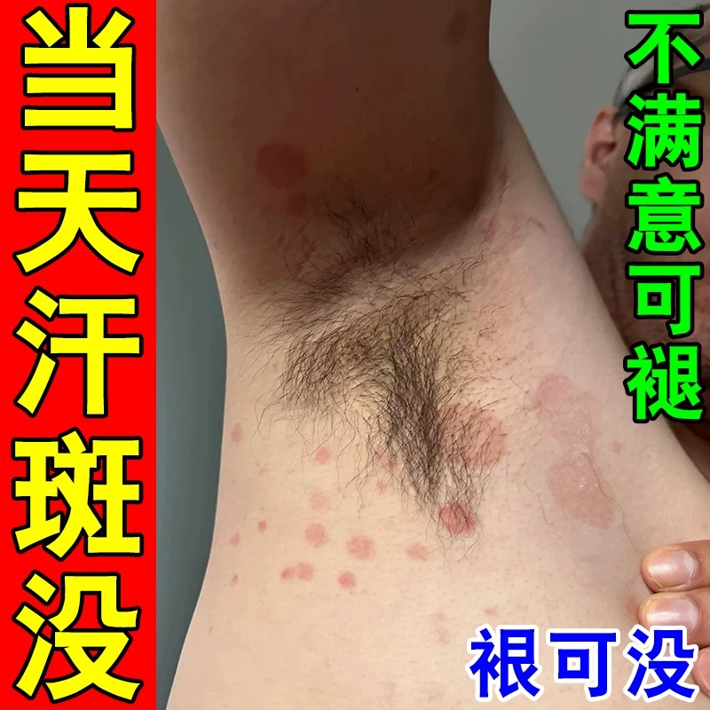 汗斑净花斑专效治褐色白斑后背用皮肤消毒护理（消）