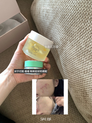 现货！一勺甜SeeUbye壬二酸控油舒缓祛痘膏退红