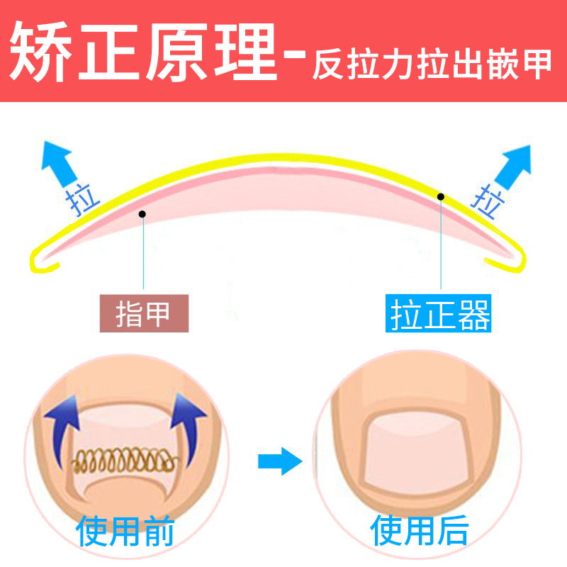 指甲长肉里不锈钢物理矫正修甲钳