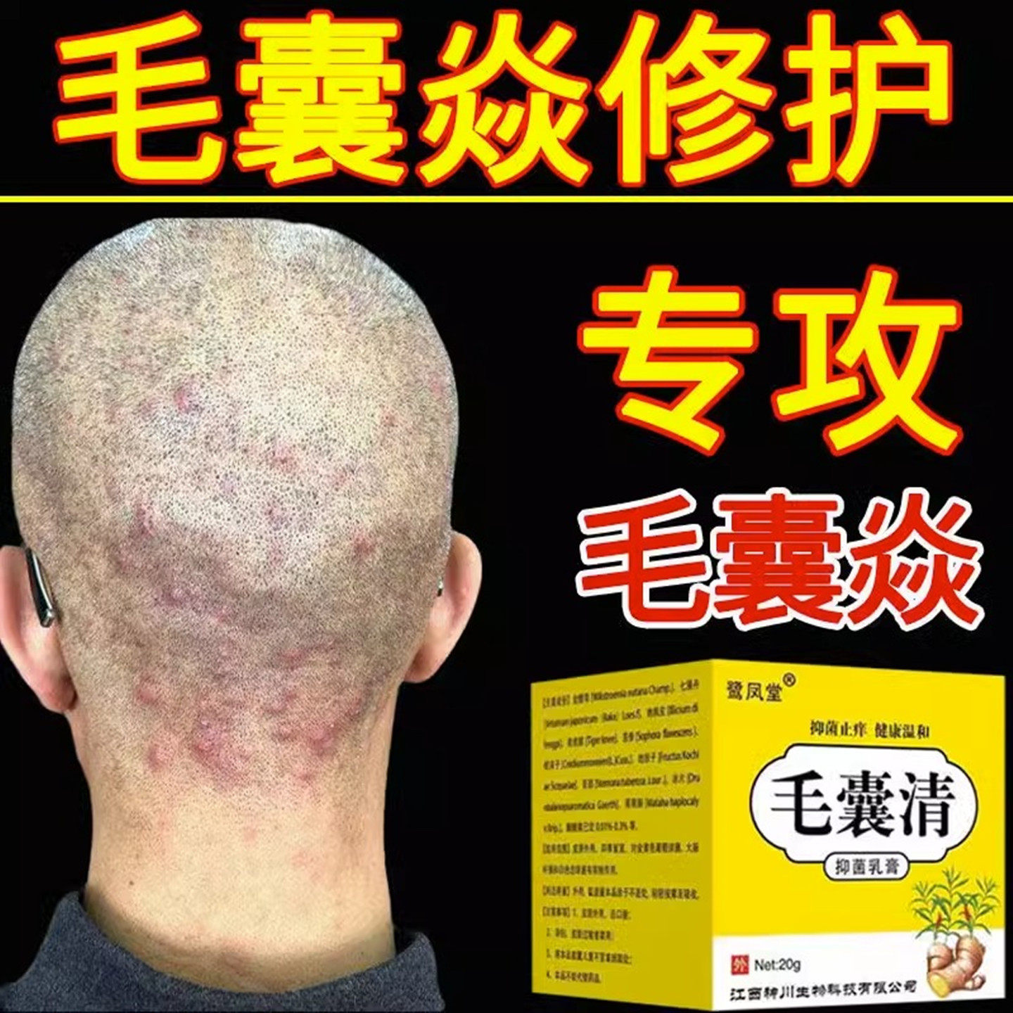 毛囊炎膏可挖裉红疙瘩脓包痘痘头皮头部背部脖子止痒专用瘙痒软膏