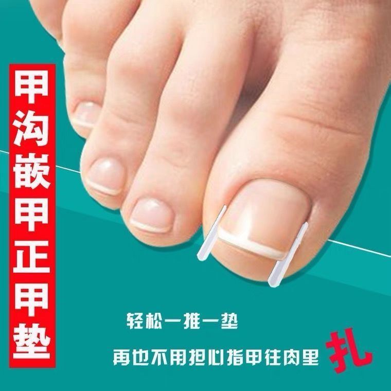 甲沟嵌甲矫正器正甲垫填充垫指甲往肉里长隔离垫纠正脚趾甲贴片炎