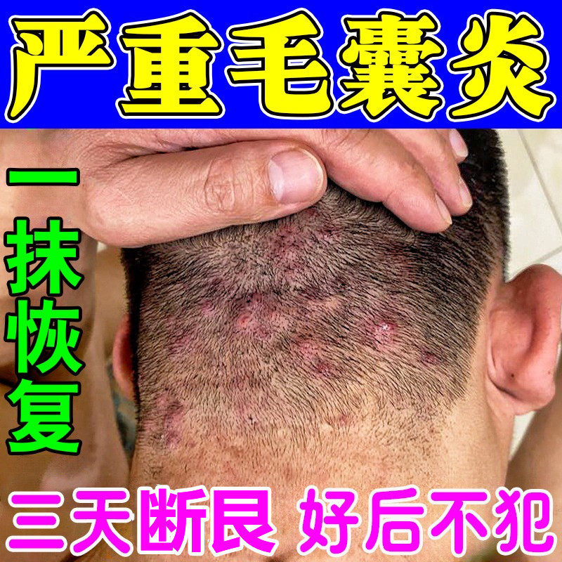 头皮毛囊炎效特膏专用头上长痘痘红疙瘩脓包红肿痒疼止痒抑菌软膏