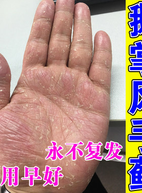 鹅掌风专用药手癣手脚严重脱皮干裂菌抑止痒膏手气手上小水泡真菌
