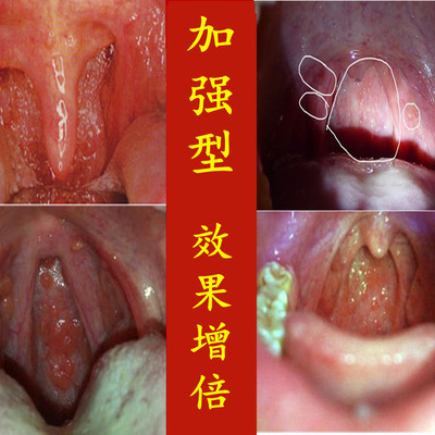 治干痒咳嗽异物感疼加强型咽炎茶