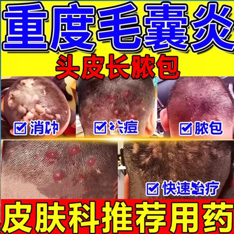 头部头皮痒有疙瘩身长痘痘专用膏