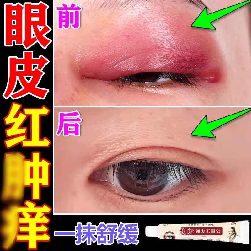 眼皮红肿痒眼睛周围过敏发痒干燥起皮眼角痒神经性痒去痒膏