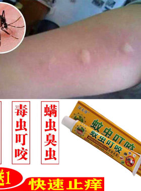 跳蚤咬止痒药膏蚊虫叮咬