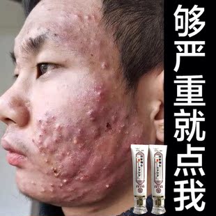 【祛除痘印坑】祛痘膏去痘印医用祛痘印去痘坑淡化痘印痘疤去痘痘