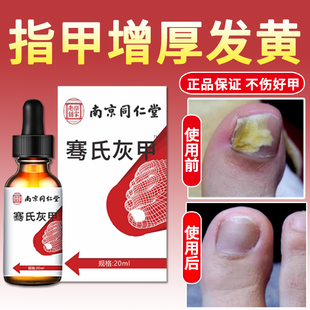 指甲增厚修复液指甲增厚用什么药真菌感染发黄增厚灰甲专用抑菌液