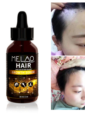 minoxidil hair growth serum anti loss slip scalp care头发液
