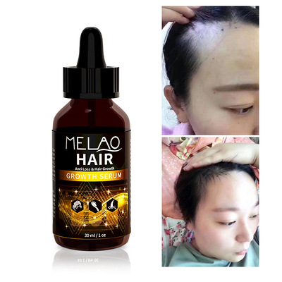minoxidilhairserum护发精油素