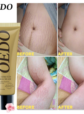 RemovesStretchMarkCream乳霜