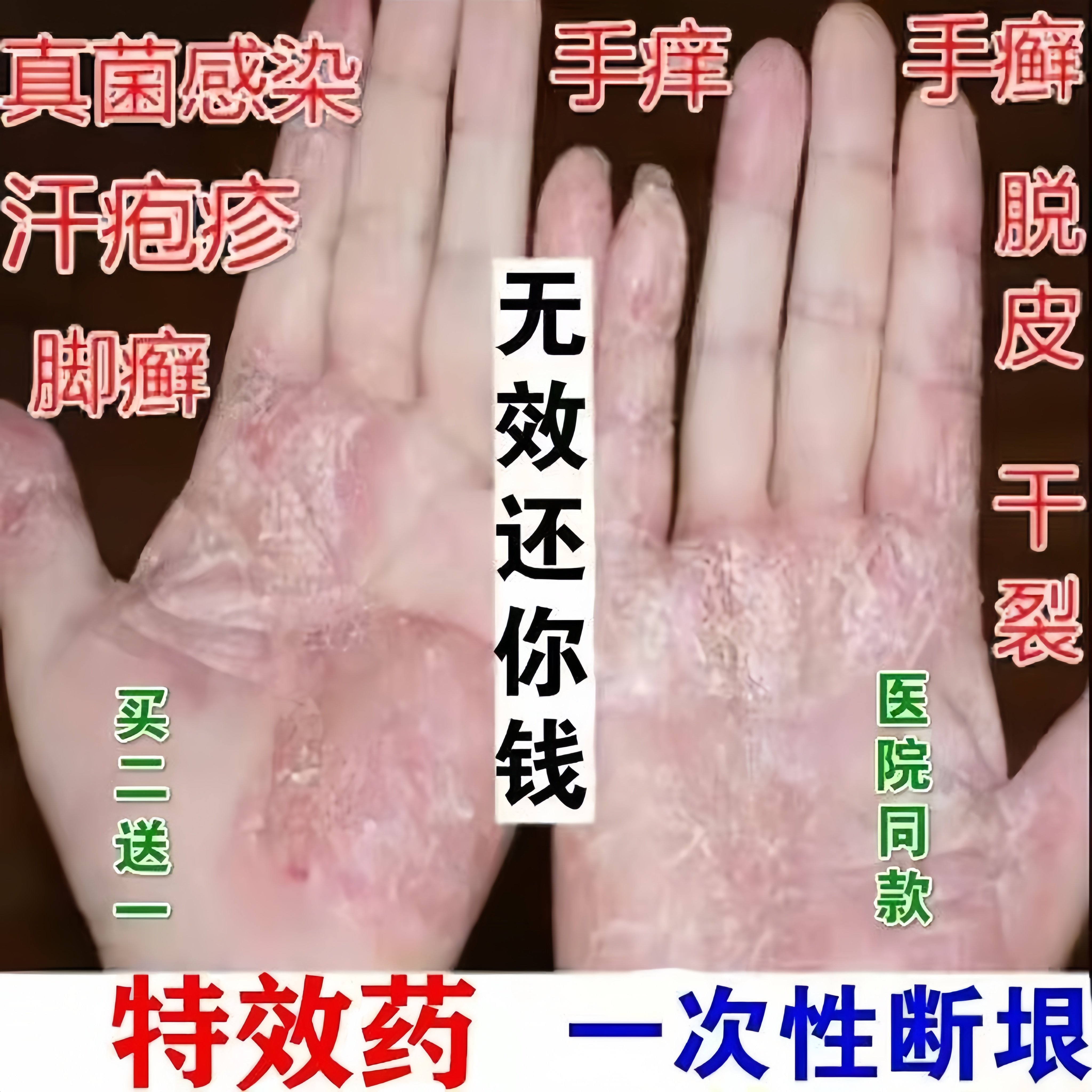 汗疱疹汗状疱疹专用软膏手上起小水泡手痒脱皮干裂痒鹅掌风药膏