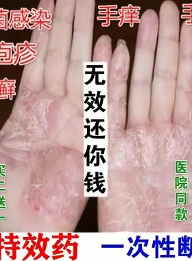 汗疱疹汗状疱疹专用软膏手上起小水泡手痒脱皮干裂痒鹅掌风药膏