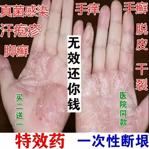 汗疱疹汗状疱疹专用软膏手上起小水泡手痒脱皮干裂痒鹅掌风药膏