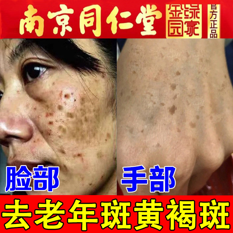 同仁堂祛斑霜正品美白黄褐斑手部脸部老年斑强力去除专用膏