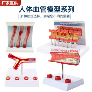人体支脉粥样堵塞心血管模型血栓血液浓度脂肪病理粥样硬化解剖